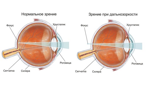 Дальнозоркость