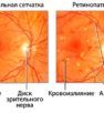 Проявления фоновой ретинопатии у человека