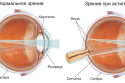 Нарушение зрения при астигматизме