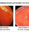 Причины и лечение заболеваний сетчатки глаза