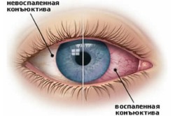 Конъюктивит - причина слезоточивости глаз