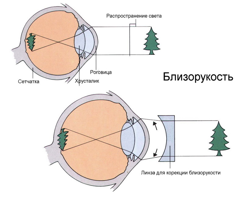 Близорукость картинка глаза