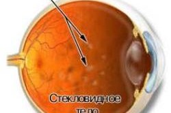 Плавающие помутнения как причина появления пятен перед глазами