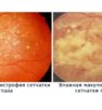 Профилактика и лечение дистрофии сетчатки глаза
