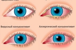 Виды конъюктивита
