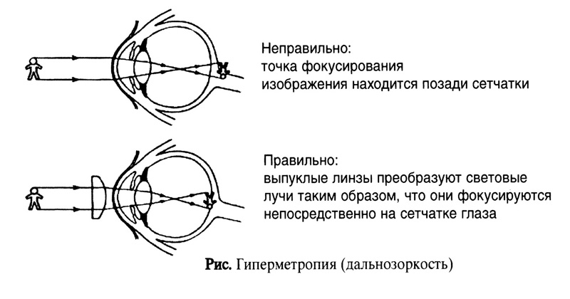 При миопии изображение фокусируется