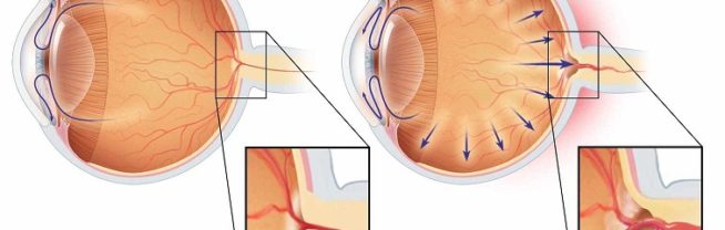 Признаки и симптомы катаракты и глаукомы