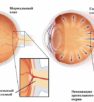 Признаки и симптомы катаракты и глаукомы
